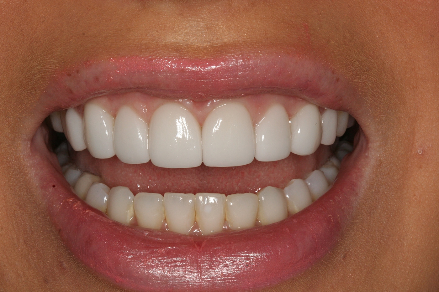A woman smiling, with a brand new top row of white teeth courtesy of new veneers.