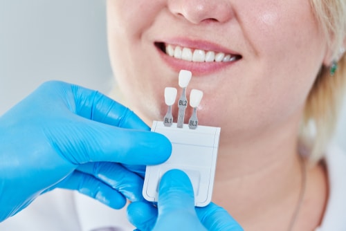 Replacement Veneers in London