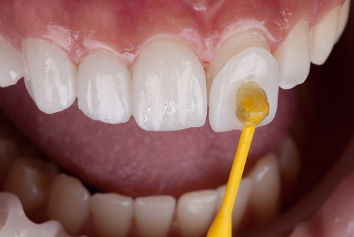 How are porcelain veneers fitted?