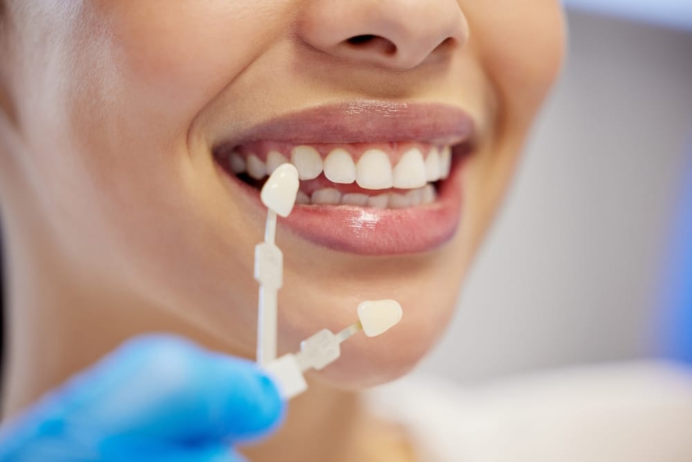 Philips Teeth Whitening London