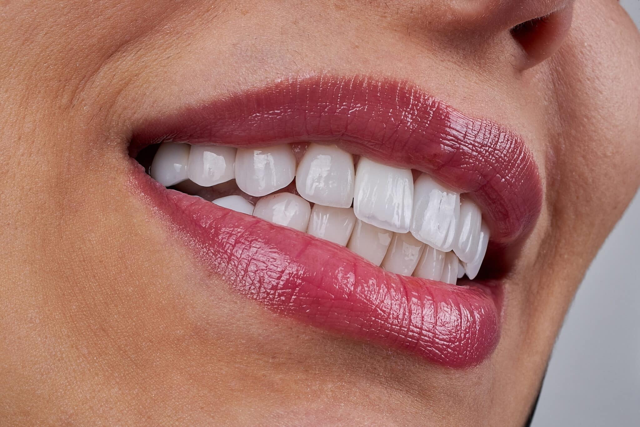 Composite Bonding in London